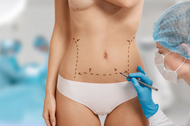 You are currently viewing Liposuction – Yağ Aldırma Operasyonu